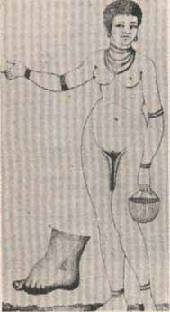 Deformacin tnica. Exagerado desarrollo de las ninfas en una mujer hotentota. Jacques L. Moreau de la Sarthe, Histoire Naturelle de la Femme, Pars, 1803.