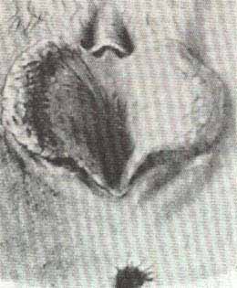 Longuininfia. Gran hipertrofia de los labios menores en figura de corazn.